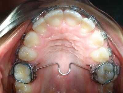 Les joies adolescentes : l'appareil dentaire.