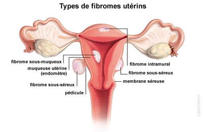 Remède naturel contre les fibromes