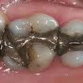 METAUX DENTAIRES: ALLIAGES METALLIQUES UTILISES EN DENTISTERIE/ELECTROGALVANISME/CONSEQUENCES SUR LA SANTE