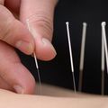 L'acupuncture, ça marche ? 