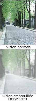 Cataracte
