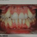 3ème rdv orthodontiste - J+3 mois et demi