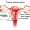 Remède naturel contre les fibromes